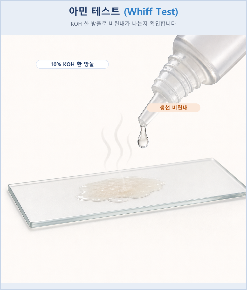 분비물에 KOH를 떨어뜨려 비린내를 확인하는 아민 테스트